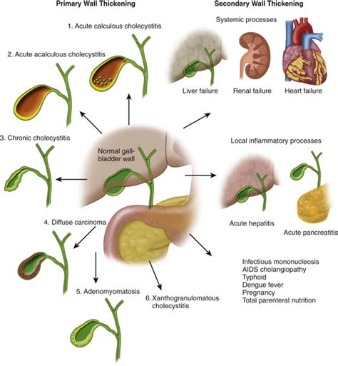 normal gallbladder wall thickness measurement|distended gallbladder with wall thickening.